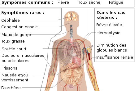Symptômes de l'infection à corona